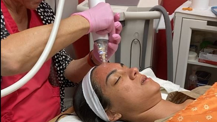 Potenza RF Microneedling